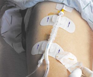 Statlock IAB Stabilization Device