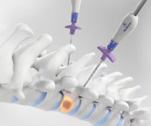 OsteoCool™ RF ablation system