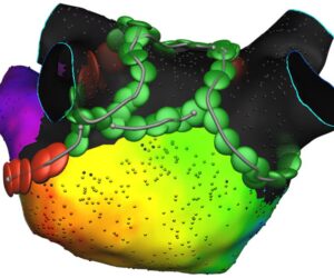 Affera™ mapping system